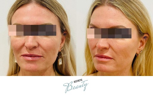 Threads Before and After Image