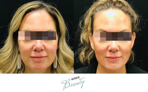 Threads Before and After Image