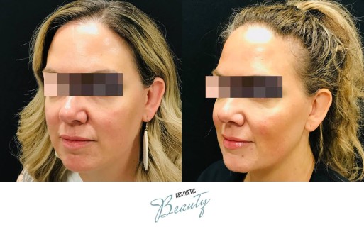 Threads Before and After Image