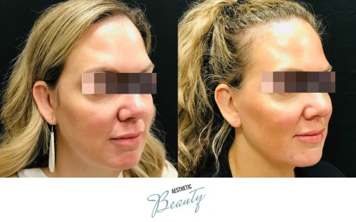 Threads Before and After Image