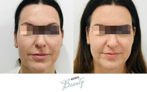 Threads Before and After Image