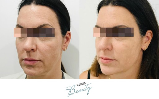 Threads Before and After Image