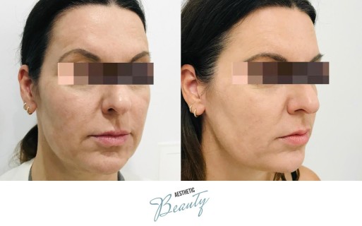 Threads Before and After Image