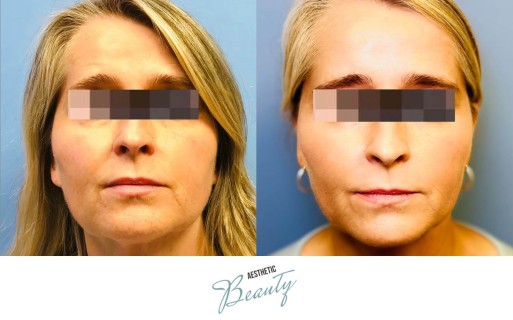 Threads Before and After Image