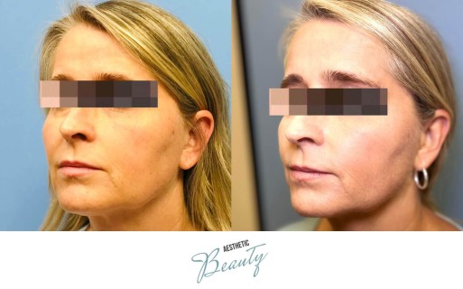 Threads Before and After Image