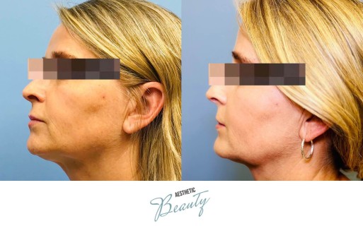 Threads Before and After Image