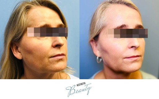 Threads Before and After Image