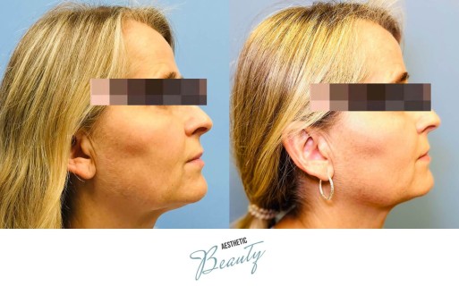 Threads Before and After Image