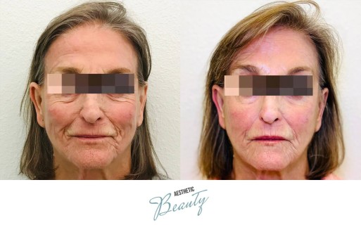 Threads Before and After Image