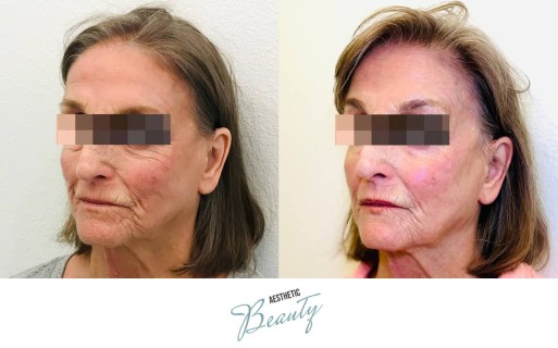 Threads Before and After Image