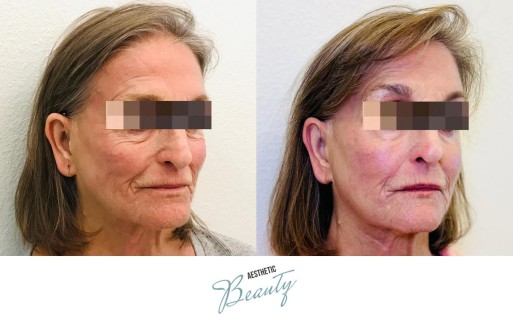 Threads Before and After Image