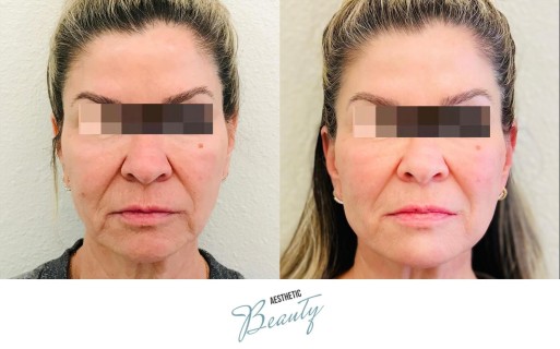 Threads Before and After Image