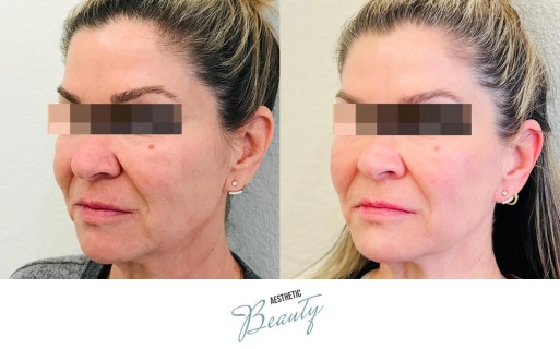 Threads Before and After Image