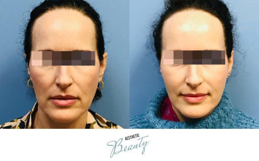 Threads Before and After Image