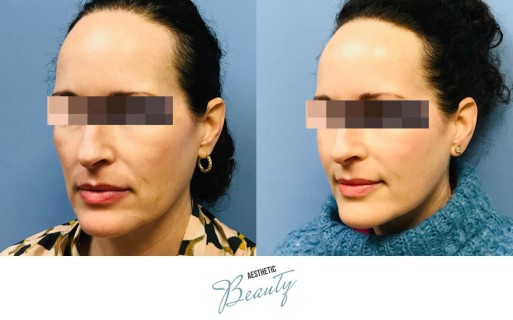 Threads Before and After Image