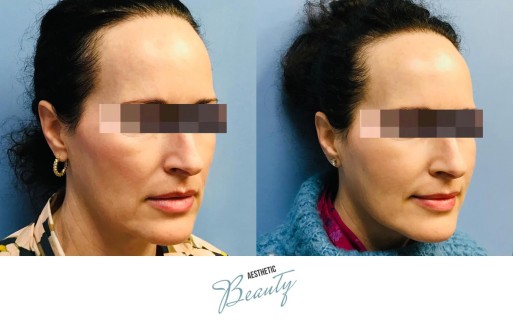 Threads Before and After Image