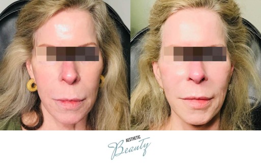 Threads Before and After Image