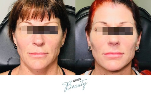 Threads Before and After Image