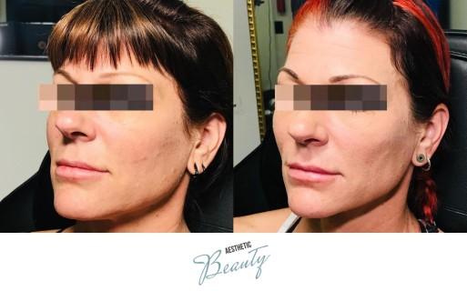 Threads Before and After Image