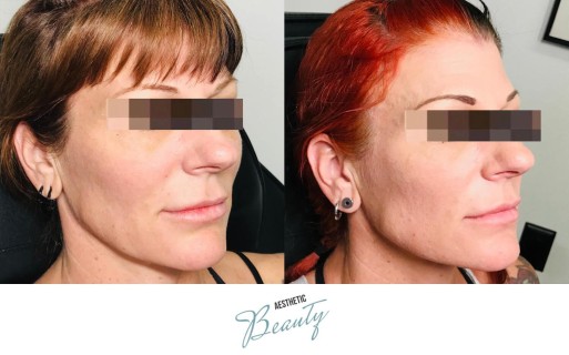 Threads Before and After Image