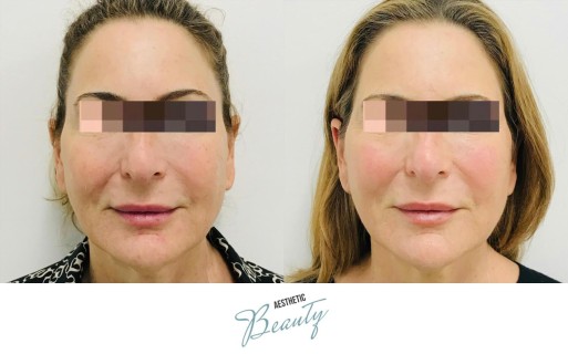 Threads Before and After Image