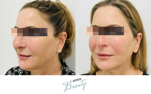 Threads Before and After Image