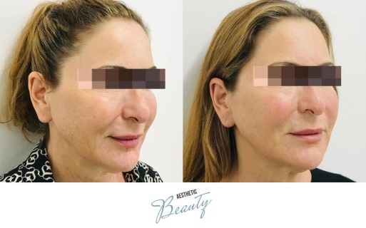 Threads Before and After Image