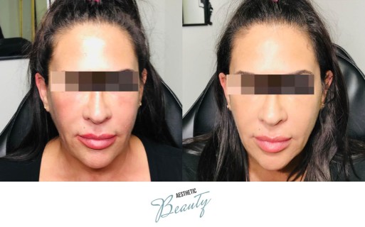 Threads Before and After Image