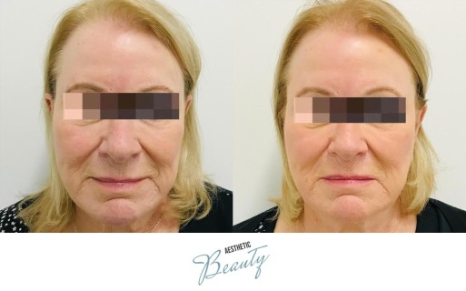 Threads Before and After Image