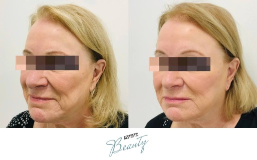 Threads Before and After Image