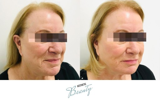 Threads Before and After Image