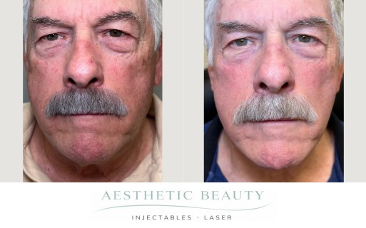 Ultra Clear Before and After Image
