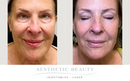 Ultra Clear Coring Before and After Image