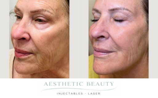 Ultra Clear Coring Before and After Image
