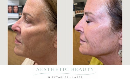 Ultra Clear Coring Before and After Image