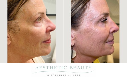 Ultra Clear Coring Before and After Image