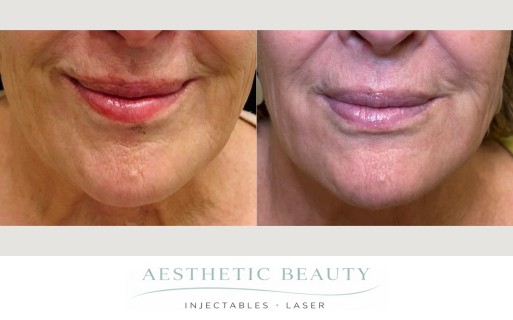 Ultra Clear Coring Before and After Image