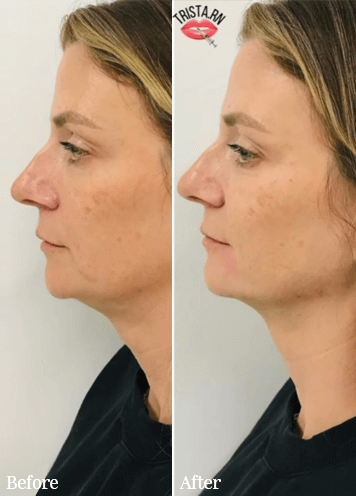 Before and after pictures of a patient from Aesthetic Beauty