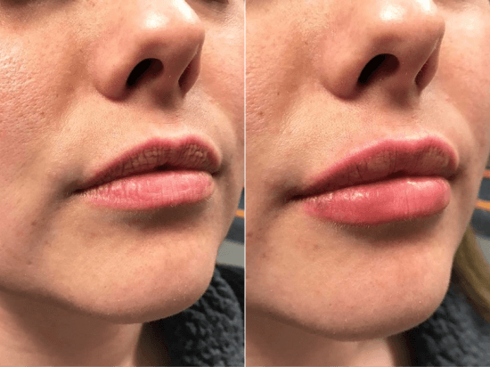 Lip fillers before and after patient
