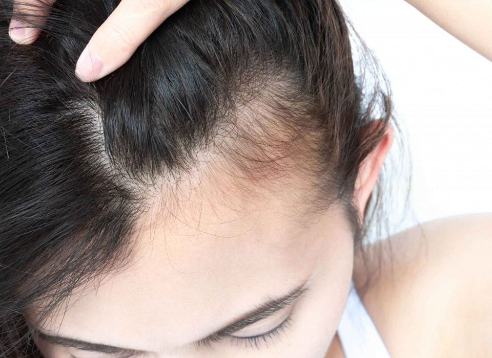 Image of a model girl showing her hair and scalp