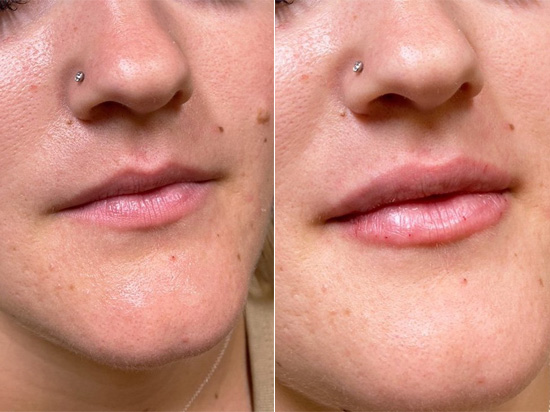 Lip fillers before and after patient