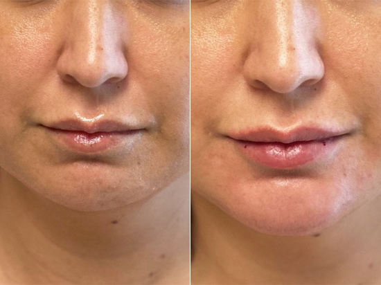 Lip fillers before and after patient