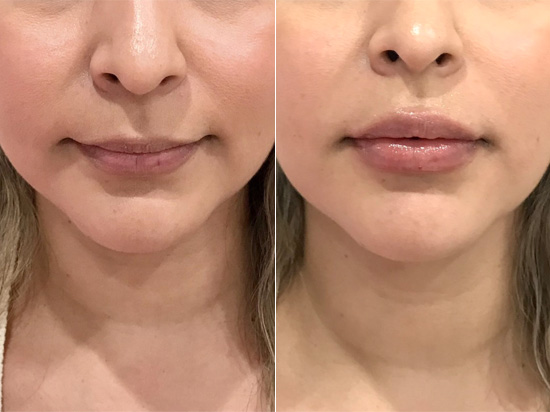 Lip fillers before and after patient