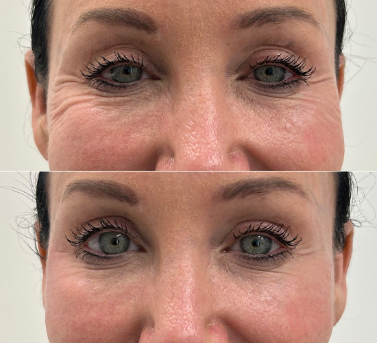 wrinkle-reduction-before-and-after-1