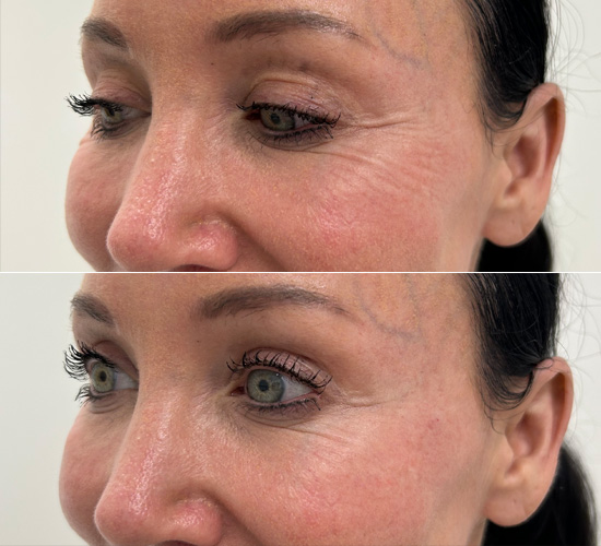 wrinkle-reduction-before-and-after-2