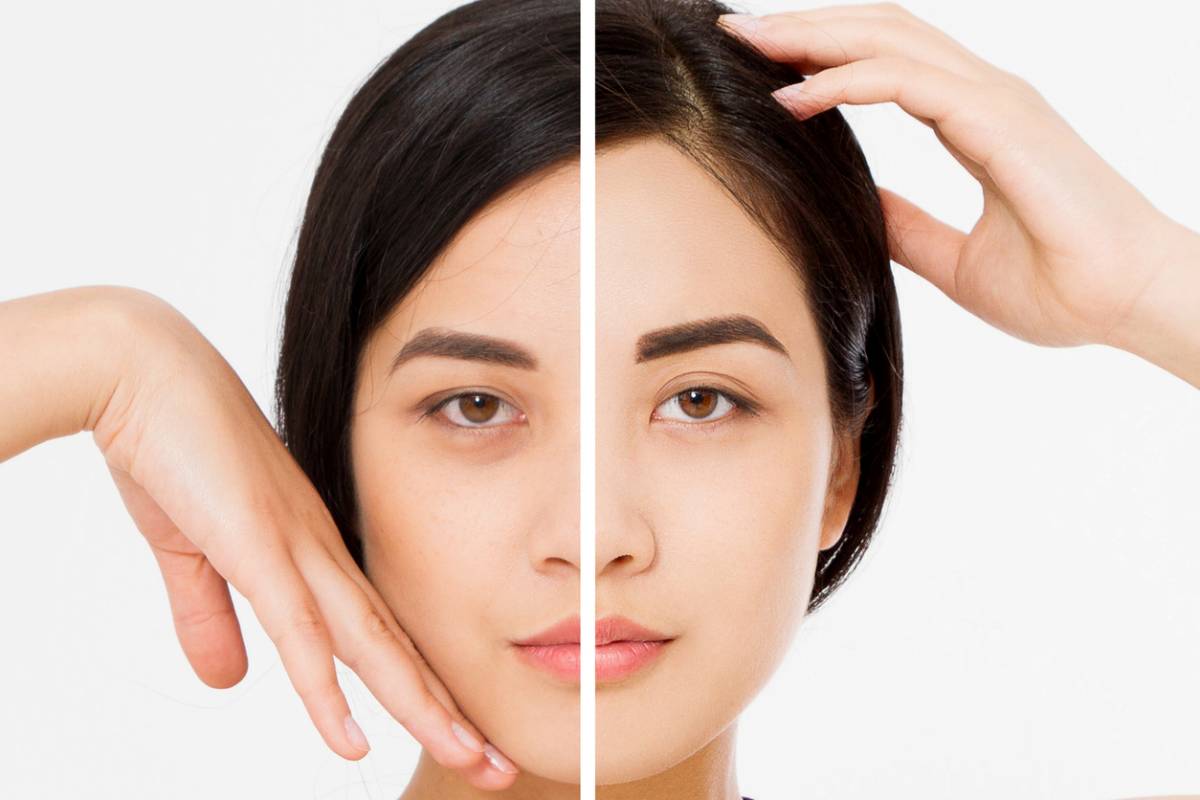 featured image for can restylane fillers improve dark circles