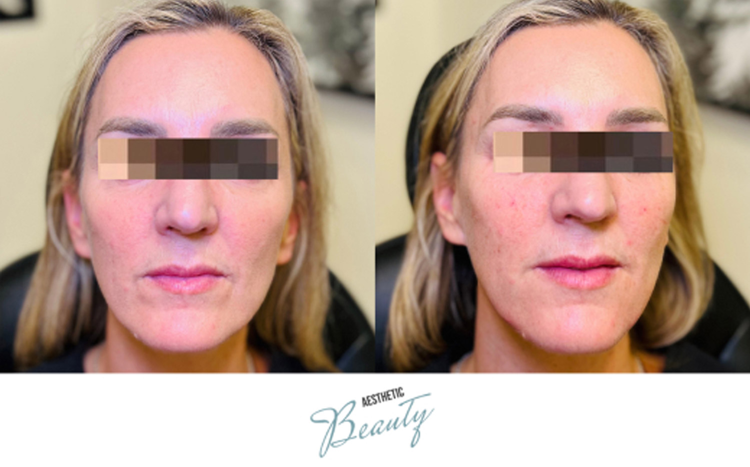 Filler - Chin and Jawline Before and After Image