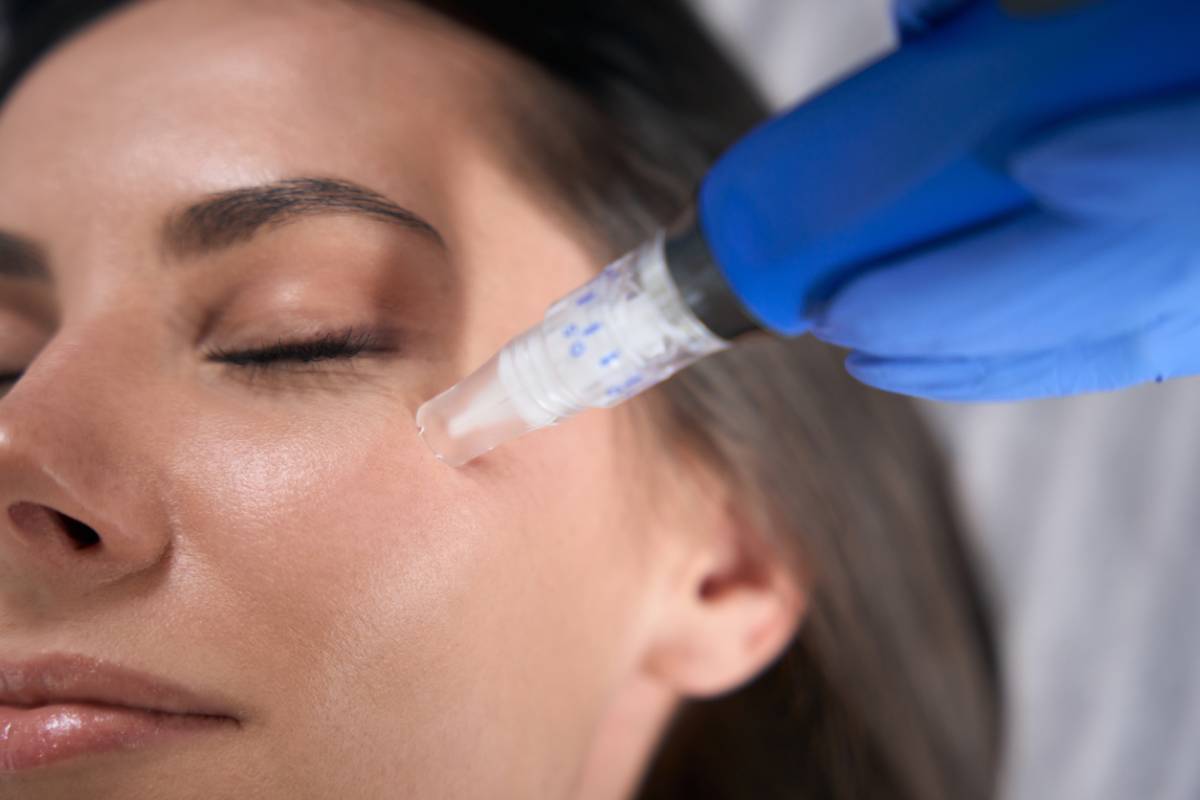Featured image for Does Microneedling Hurt: Understanding the Procedure
