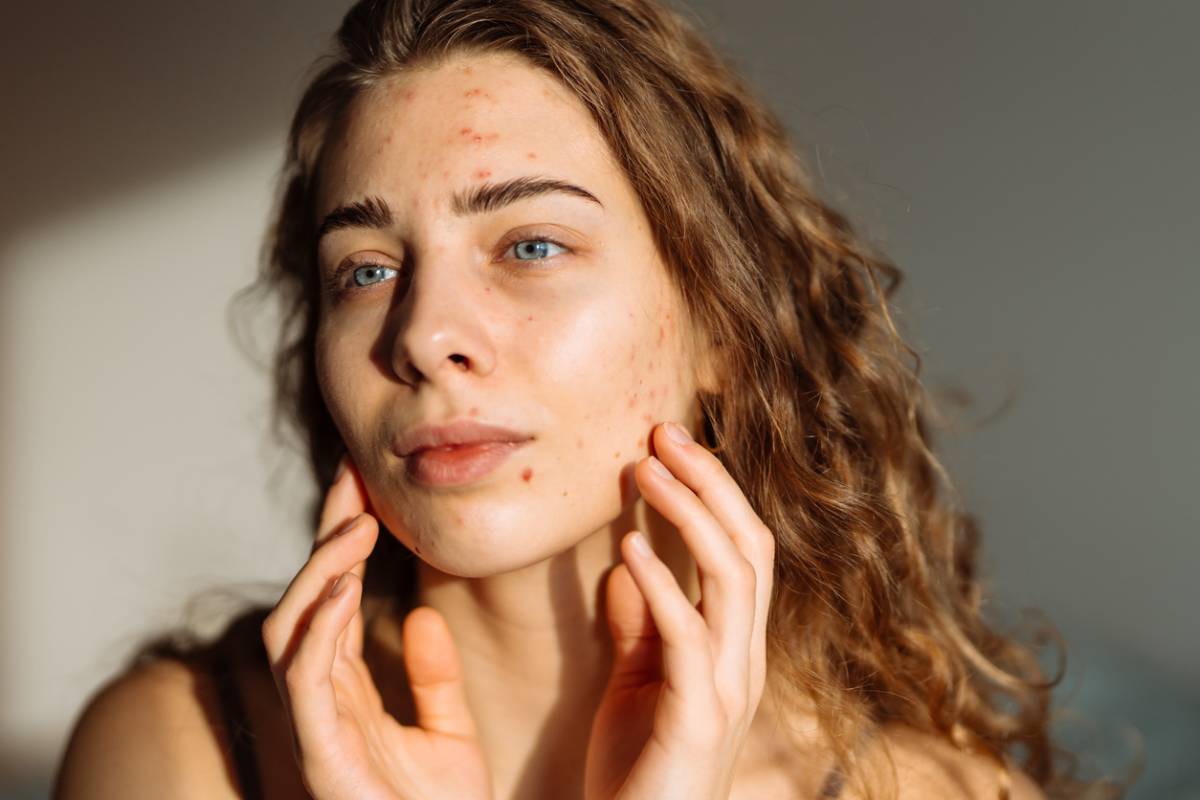 Featured image for Can EZ Gel Help With Acne Scars